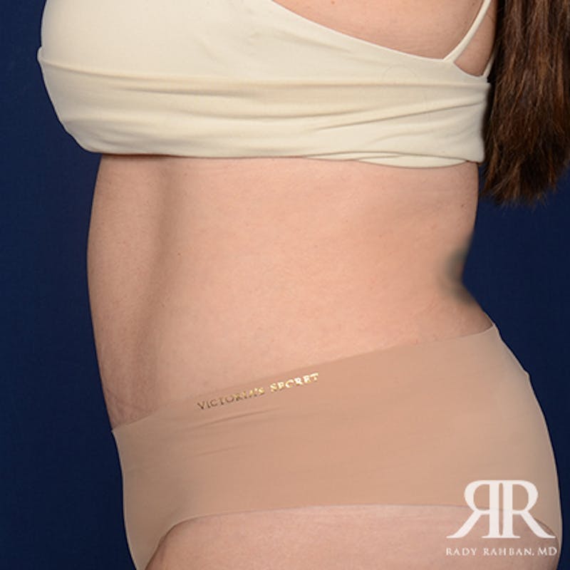 Tummy Tuck Before & After Gallery - Patient 122513 - Image 6