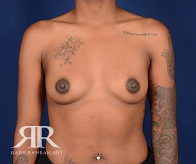 Breast Augmentation Before & After Gallery - Patient 352276 - Image 1