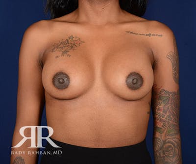 Breast Augmentation Before & After Gallery - Patient 352276 - Image 2