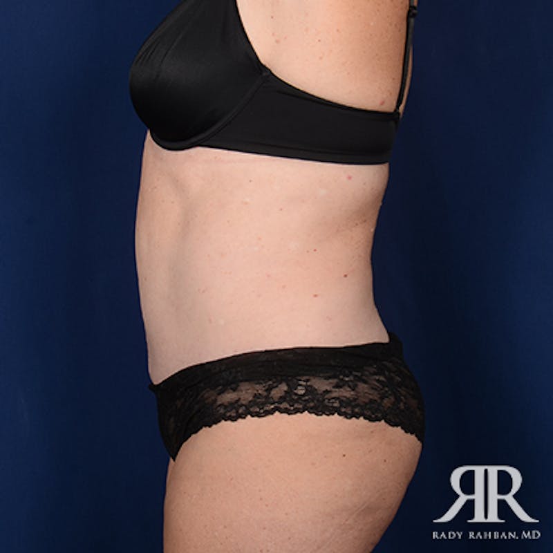 Tummy Tuck Before & After Gallery - Patient 946711 - Image 6