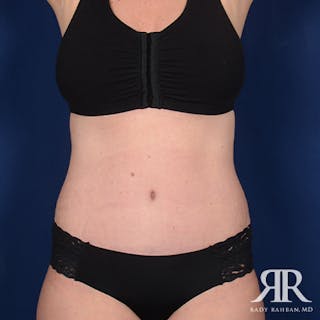 Tummy Tuck Before & After Gallery - Patient 125098 - Image 2