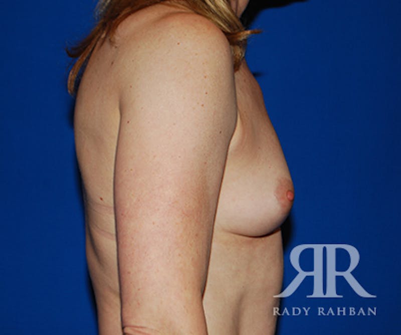 Breast Augmentation Before & After Gallery - Patient 184599 - Image 5