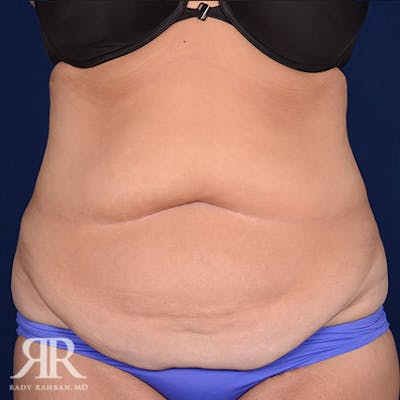 Tummy Tuck Before & After Gallery - Patient 295515 - Image 1