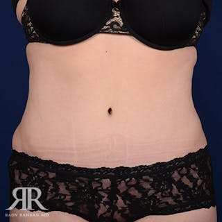 Tummy Tuck Before & After Gallery - Patient 295515 - Image 2