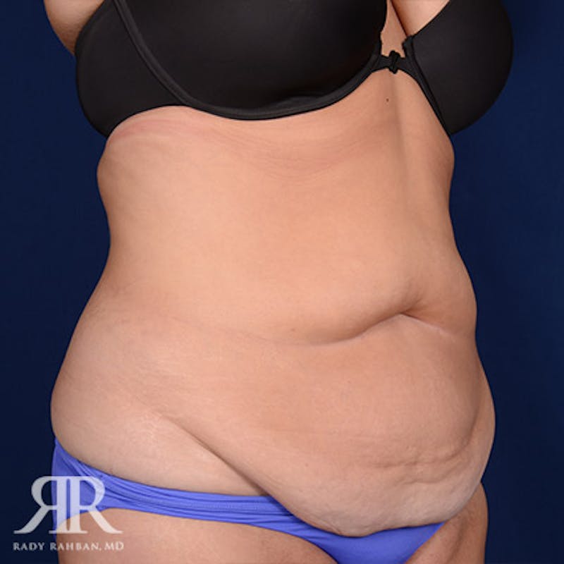 Tummy Tuck Before & After Gallery - Patient 295515 - Image 3