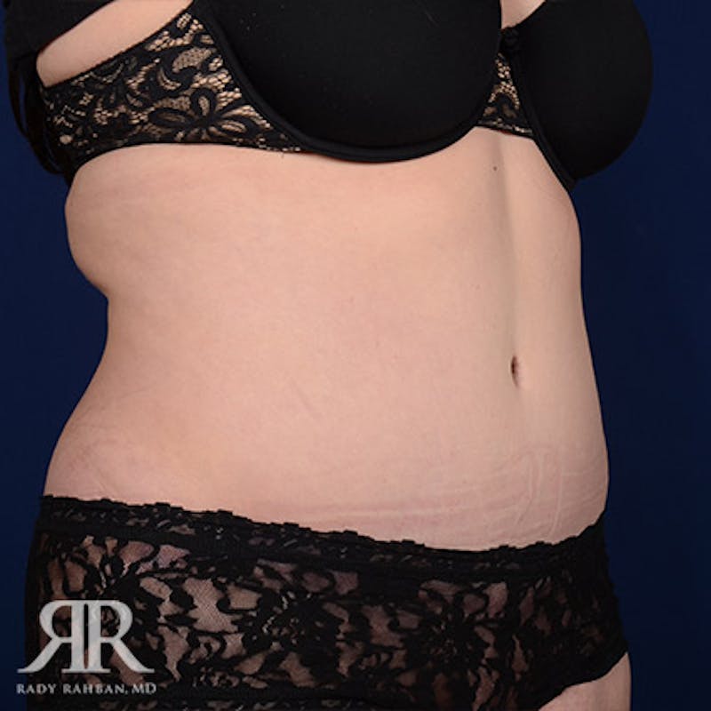 Tummy Tuck Before & After Gallery - Patient 295515 - Image 4