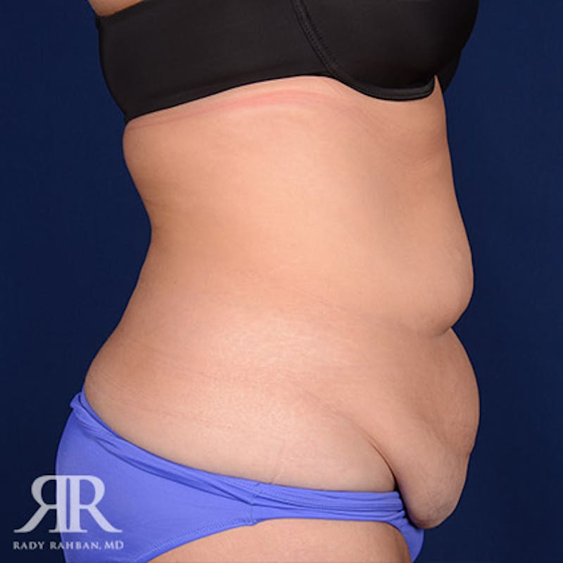 Tummy Tuck Before & After Gallery - Patient 295515 - Image 5