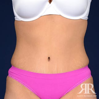 Tummy Tuck Before & After Gallery - Patient 666997 - Image 2