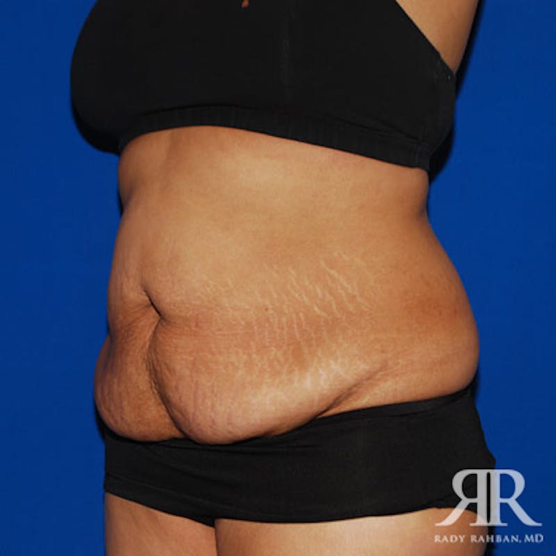 Tummy Tuck Before & After Gallery - Patient 666997 - Image 3