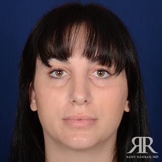 Female Rhinoplasty Before & After Gallery - Patient 161895 - Image 2