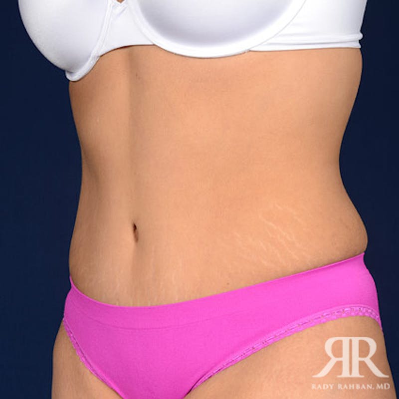 Tummy Tuck Before & After Gallery - Patient 666997 - Image 4