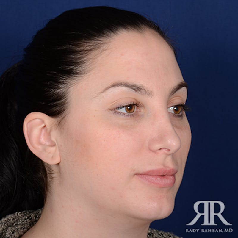 Female Rhinoplasty Before & After Gallery - Patient 161895 - Image 3