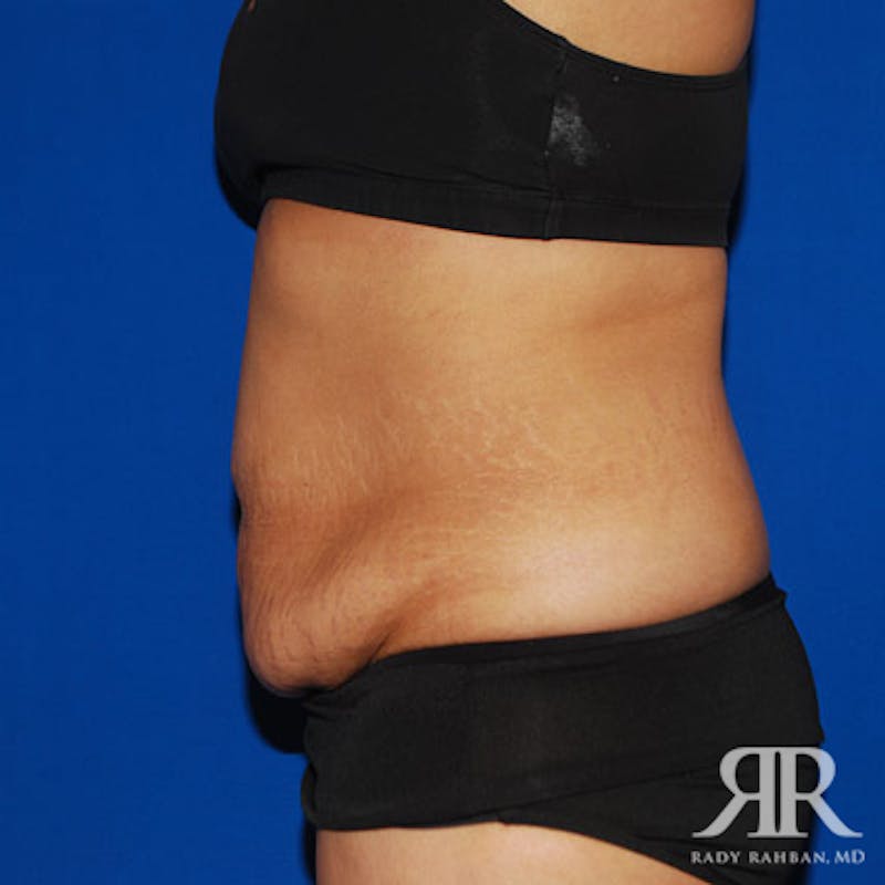 Tummy Tuck Before & After Gallery - Patient 666997 - Image 5