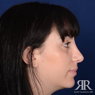 Female Rhinoplasty Before & After Gallery - Patient 161895 - Image 6