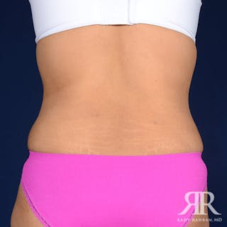 Tummy Tuck Before & After Gallery - Patient 666997 - Image 8