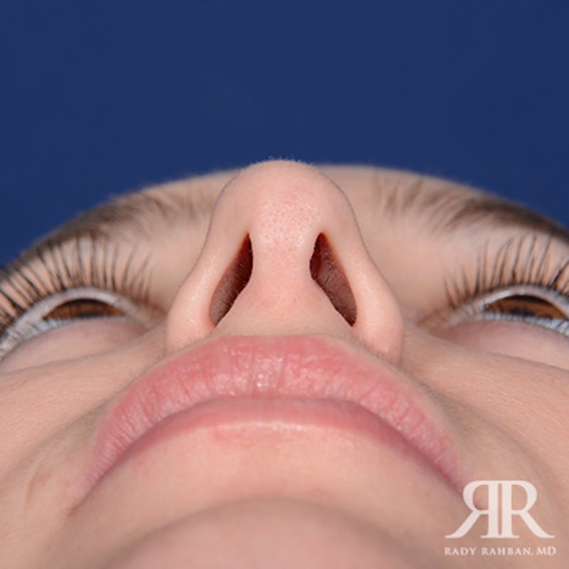 Female Rhinoplasty Before & After Gallery - Patient 161895 - Image 7
