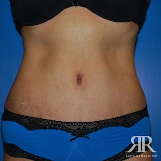 Tummy Tuck Before & After Gallery - Patient 128053 - Image 2