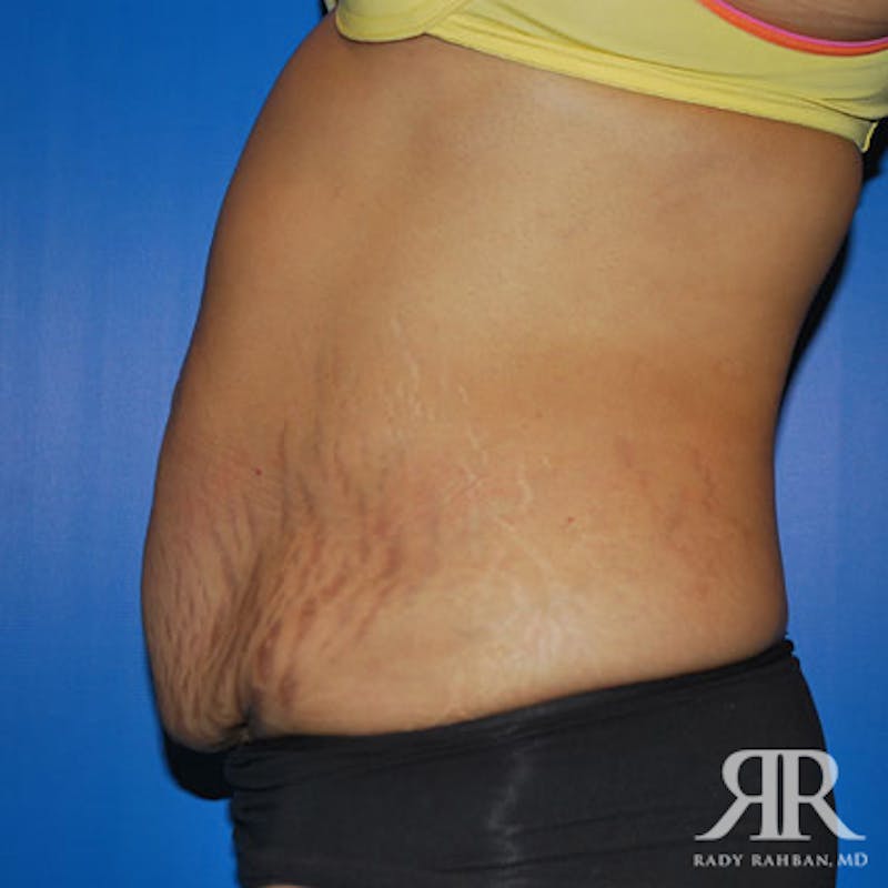 Tummy Tuck Before & After Gallery - Patient 128053 - Image 5