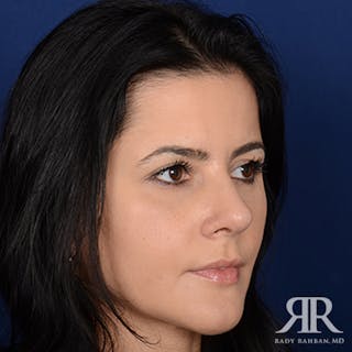 Female Rhinoplasty Before & After Gallery - Patient 365936 - Image 4