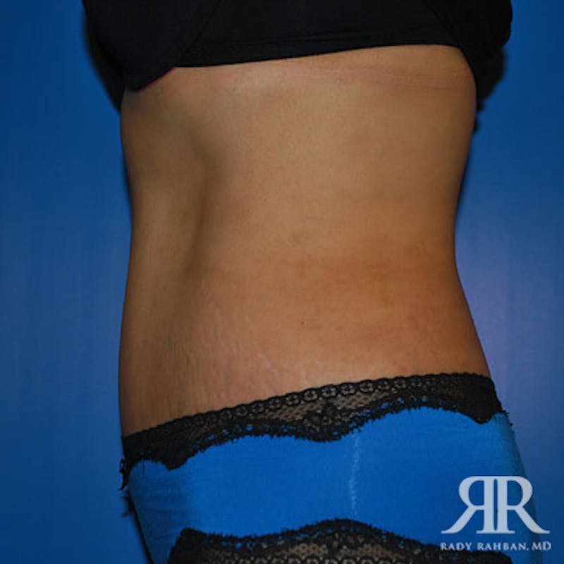 Tummy Tuck Before & After Gallery - Patient 128053 - Image 6