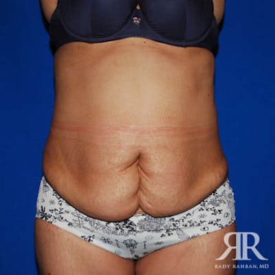Tummy Tuck Before & After Gallery - Patient 549178 - Image 1