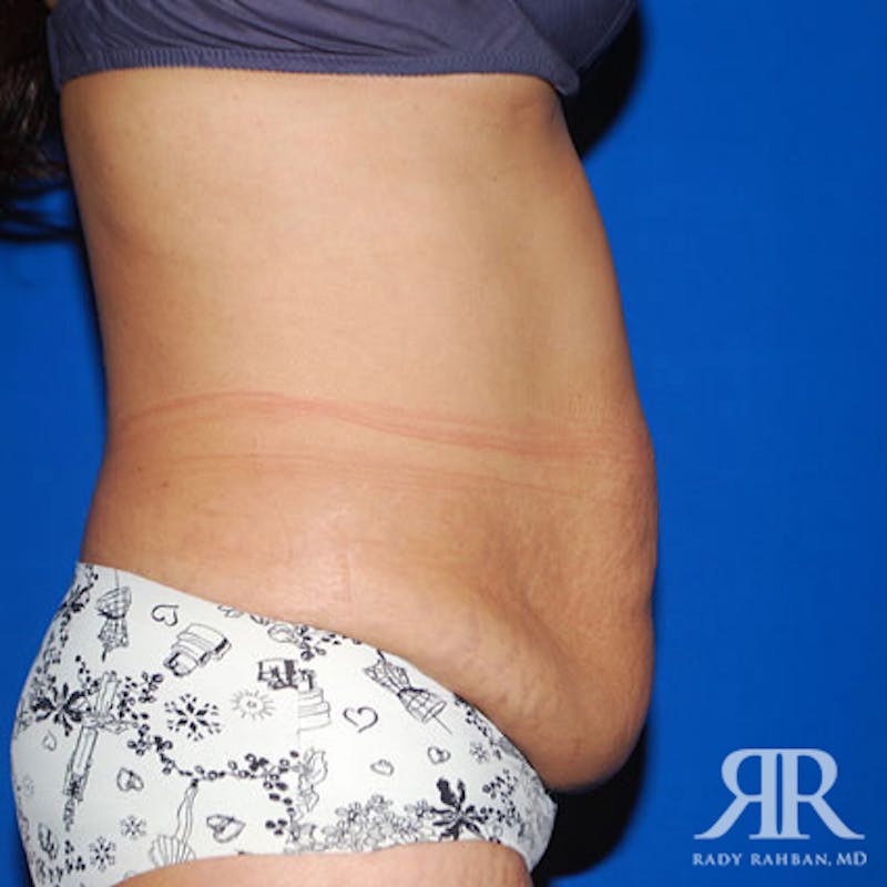 Tummy Tuck Before & After Gallery - Patient 549178 - Image 5