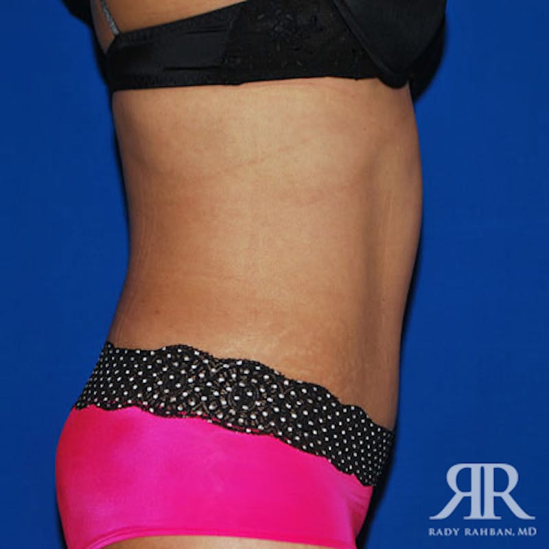 Tummy Tuck Before & After Gallery - Patient 549178 - Image 6
