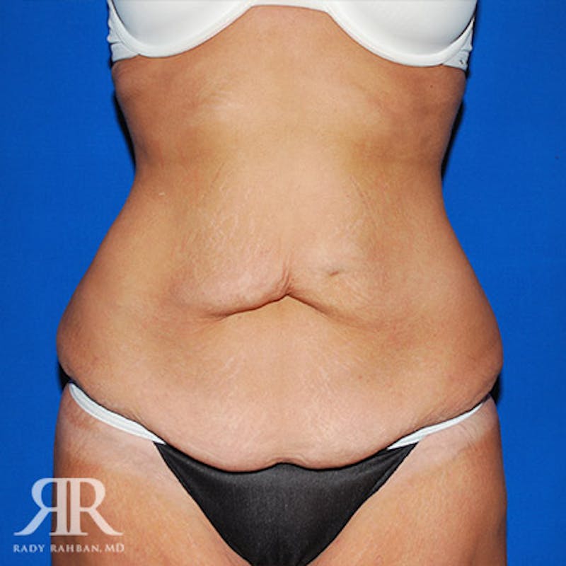 Tummy Tuck Before & After Gallery - Patient 421144 - Image 1