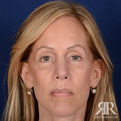 Female Rhinoplasty Before & After Gallery - Patient 227048 - Image 2