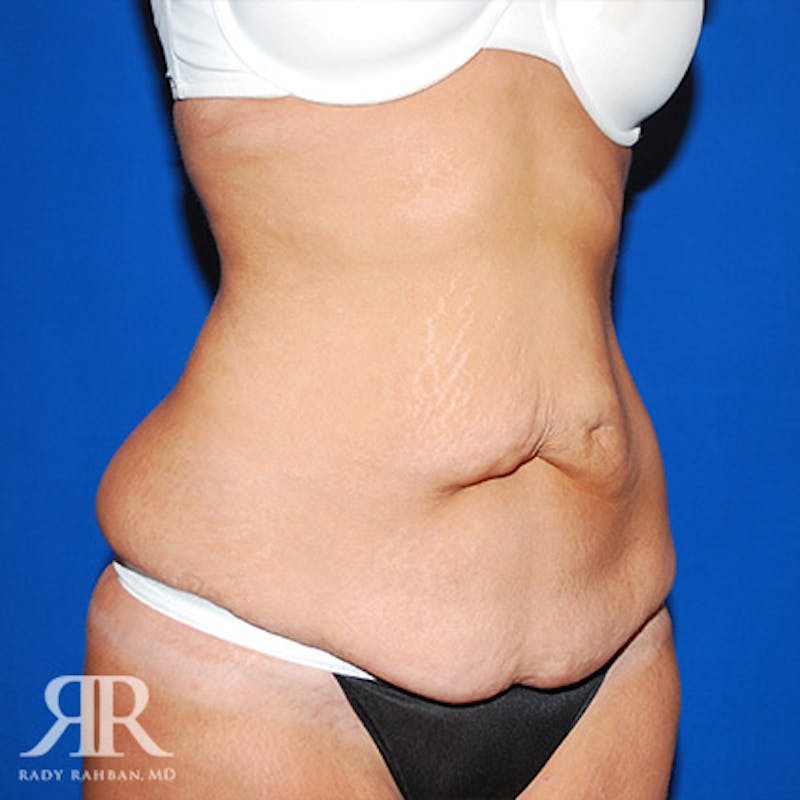 Tummy Tuck Before & After Gallery - Patient 421144 - Image 3