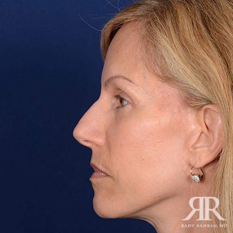 Female Rhinoplasty Before & After Gallery - Patient 227048 - Image 5