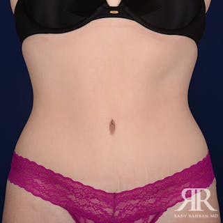 Tummy Tuck Before & After Gallery - Patient 401886 - Image 2