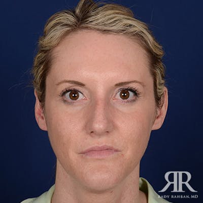 Female Rhinoplasty Before & After Gallery - Patient 867084 - Image 1