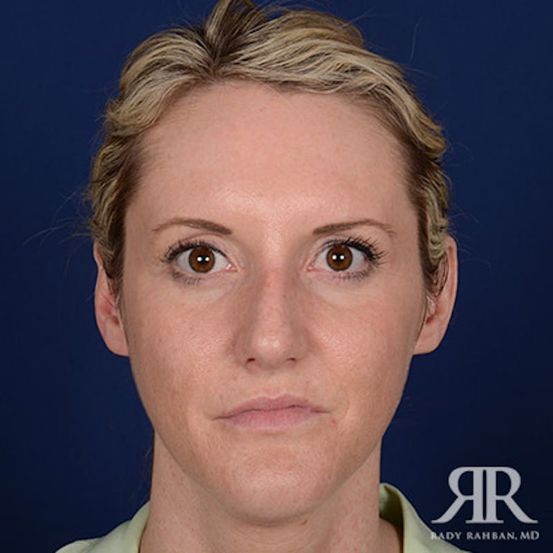Female Rhinoplasty Before & After Gallery - Patient 867084 - Image 1