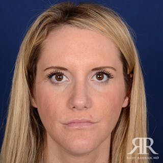 Female Rhinoplasty Before & After Gallery - Patient 867084 - Image 2