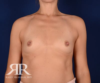 Breast Augmentation Before & After Gallery - Patient 797537 - Image 1