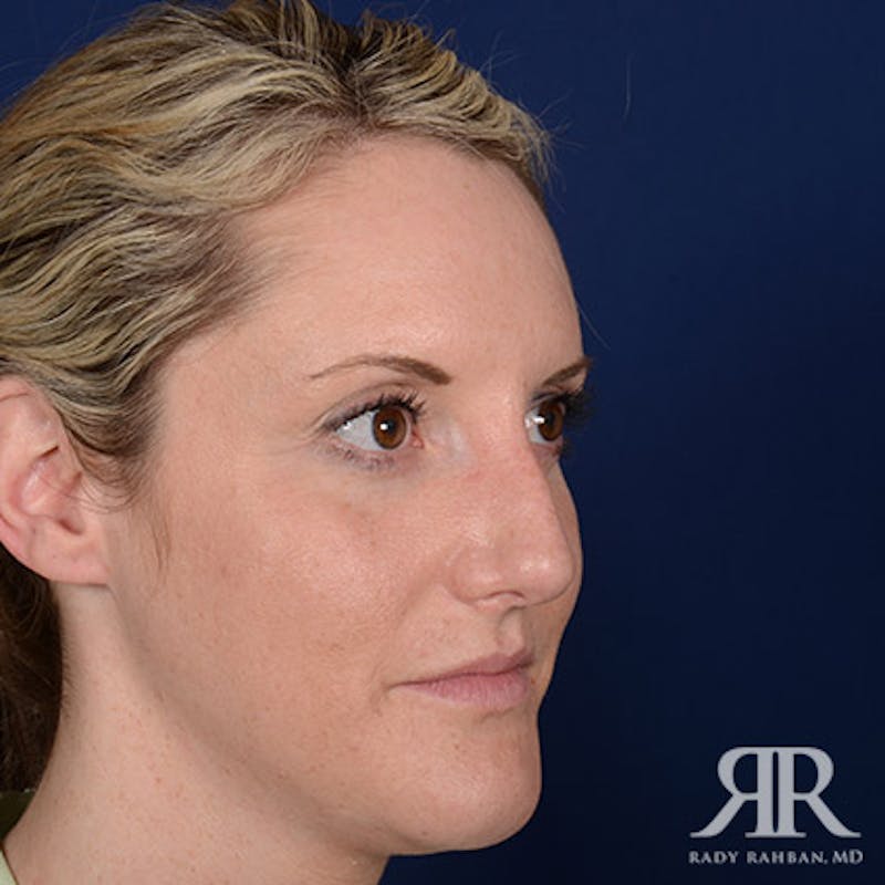 Female Rhinoplasty Before & After Gallery - Patient 867084 - Image 3