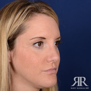 Female Rhinoplasty Before & After Gallery - Patient 867084 - Image 4