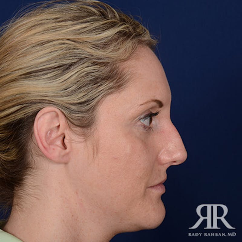 Female Rhinoplasty Before & After Gallery - Patient 867084 - Image 5