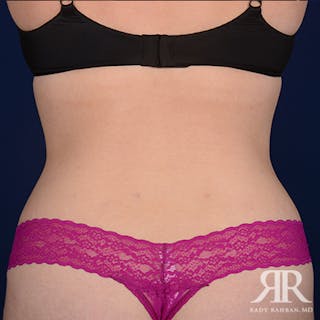 Tummy Tuck Before & After Gallery - Patient 401886 - Image 8