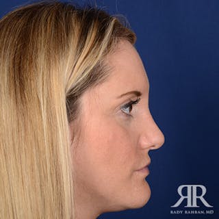 Female Rhinoplasty Before & After Gallery - Patient 867084 - Image 6