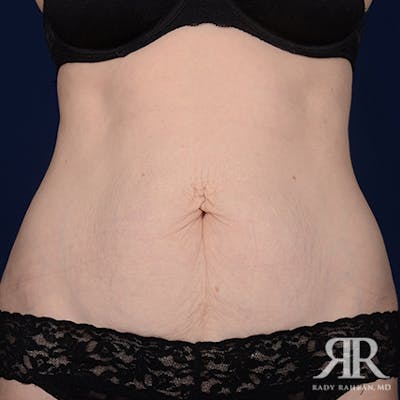 Tummy Tuck Before & After Gallery - Patient 410110 - Image 1