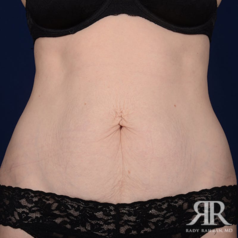 Tummy Tuck Before & After Gallery - Patient 410110 - Image 1
