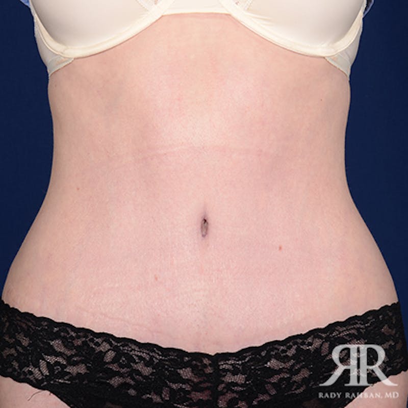 Tummy Tuck Before & After Gallery - Patient 410110 - Image 2