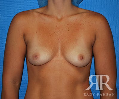 Breast Augmentation Before & After Gallery - Patient 184741 - Image 1