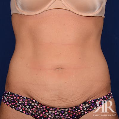 Tummy Tuck Before & After Gallery - Patient 638527 - Image 1