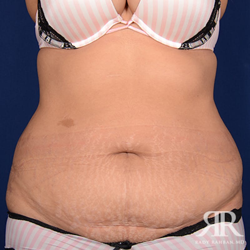 Tummy Tuck Before & After Gallery - Patient 390141 - Image 1
