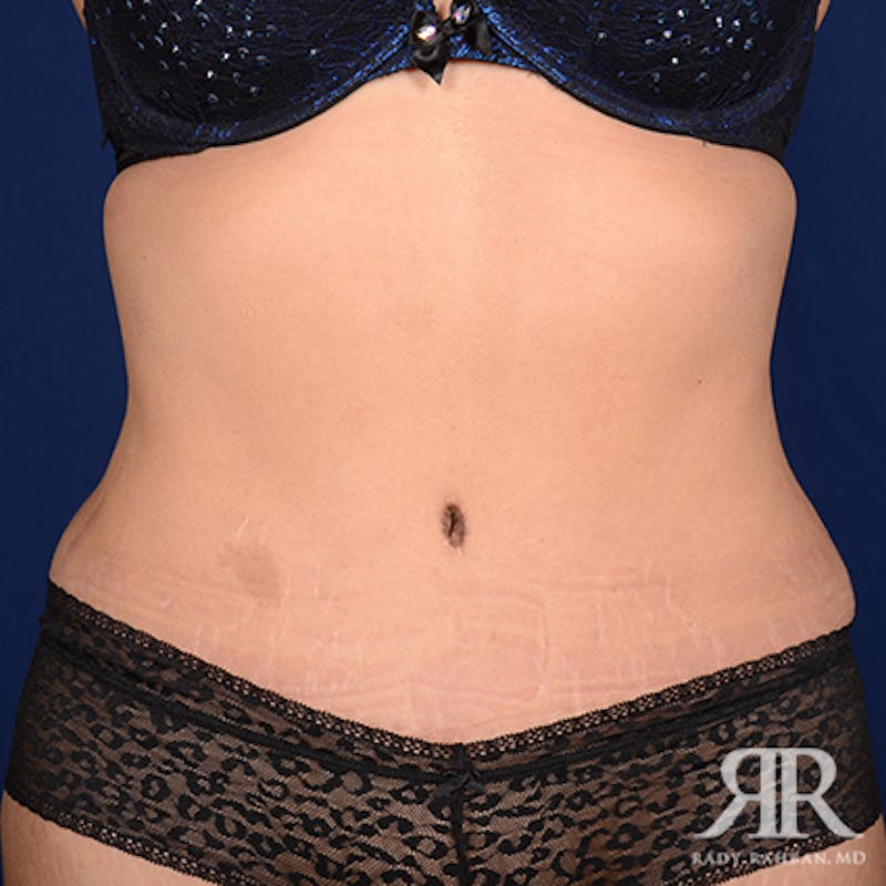 Tummy Tuck Before & After Gallery - Patient 390141 - Image 2