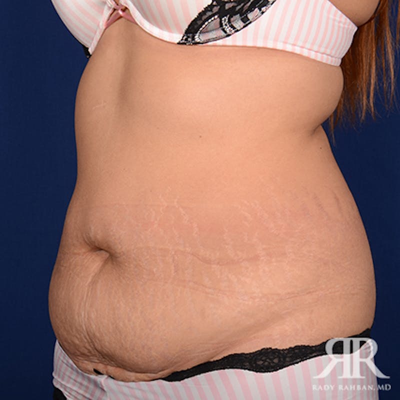 Tummy Tuck Before & After Gallery - Patient 390141 - Image 3