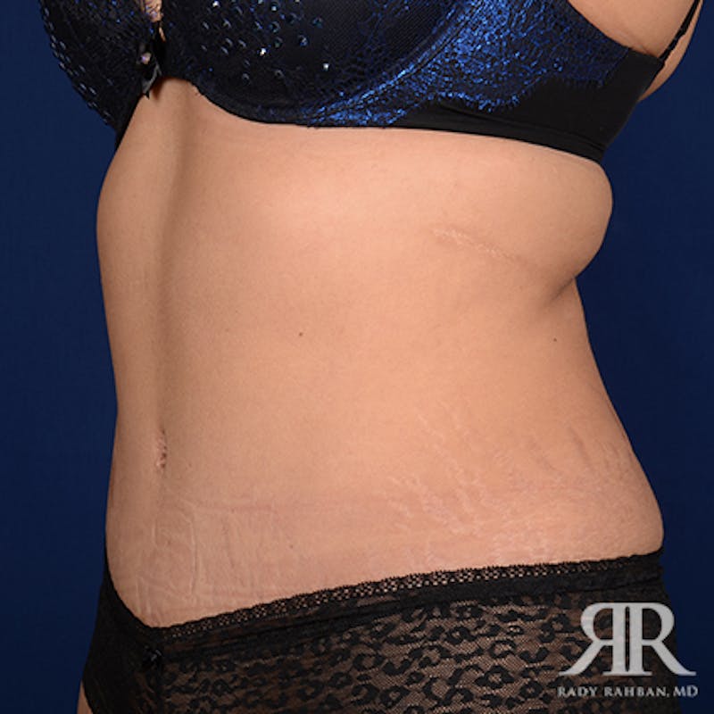 Tummy Tuck Before & After Gallery - Patient 390141 - Image 4
